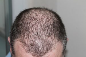 help prevent hair loss