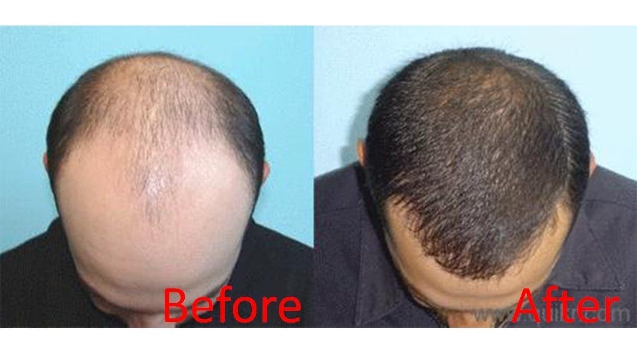Hair regrowth before and after picture